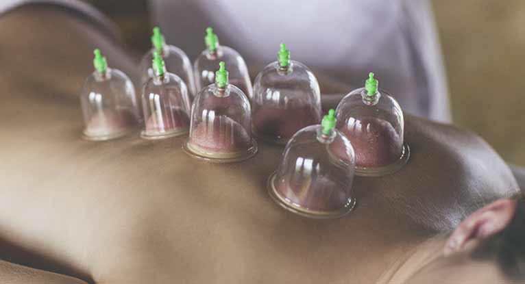 Dry Cupping Therapy